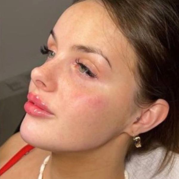 After treatment
